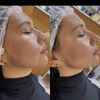 Процедура FacetemS ( колагеностимуляція)