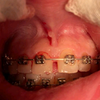 Видалення вуздечки губи/язика. Хірург-стоматолог/Phd.